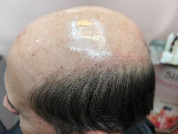 Vista superior de un cuero cabelludo con una importante pérdida de cabello, que muestra cabello natural en los laterales y la parte posterior.