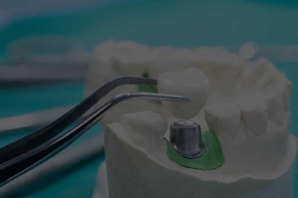 Implant Tooth Model — Dentistry Services in Cairns, QLD