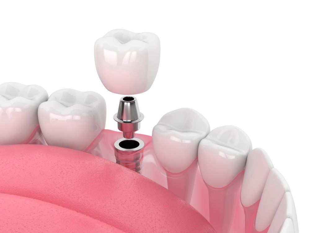 3d Render of Jaw With Dental Implant — Dentistry Services in Cairns, QLD