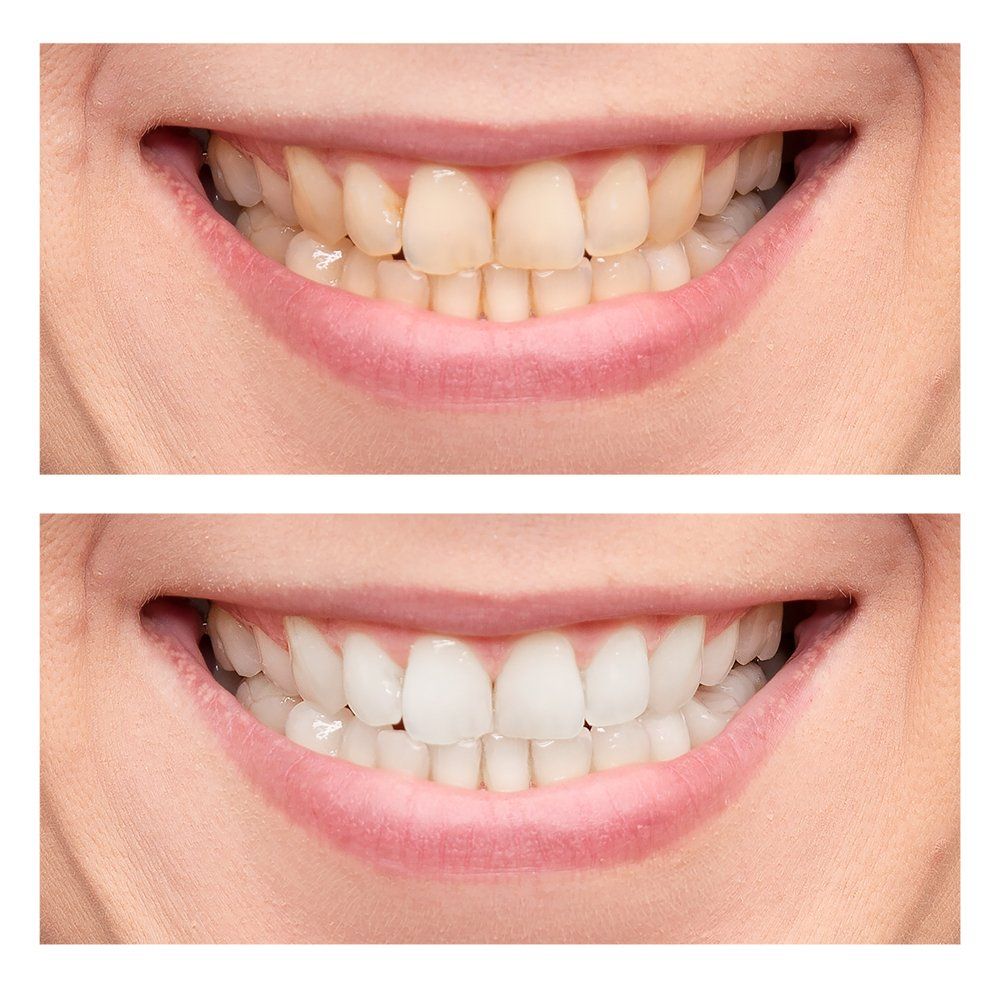 Comparison After Teeth Whitening — Dentistry Services in Cairns, QLD