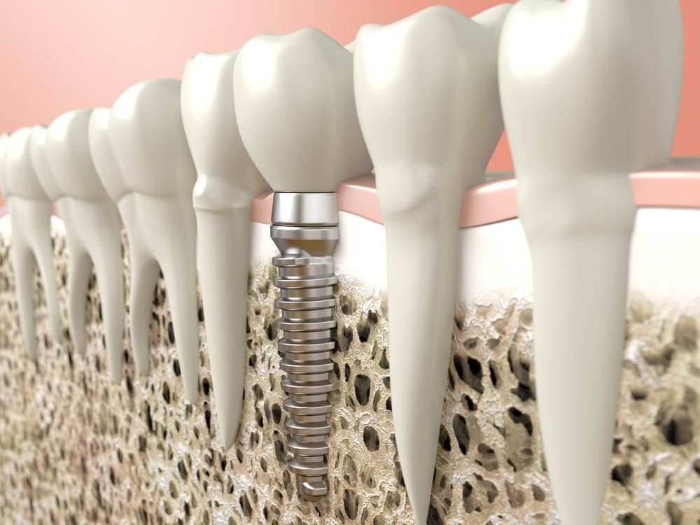 Dental Implant Model — Dentistry Services in Cairns, QLD