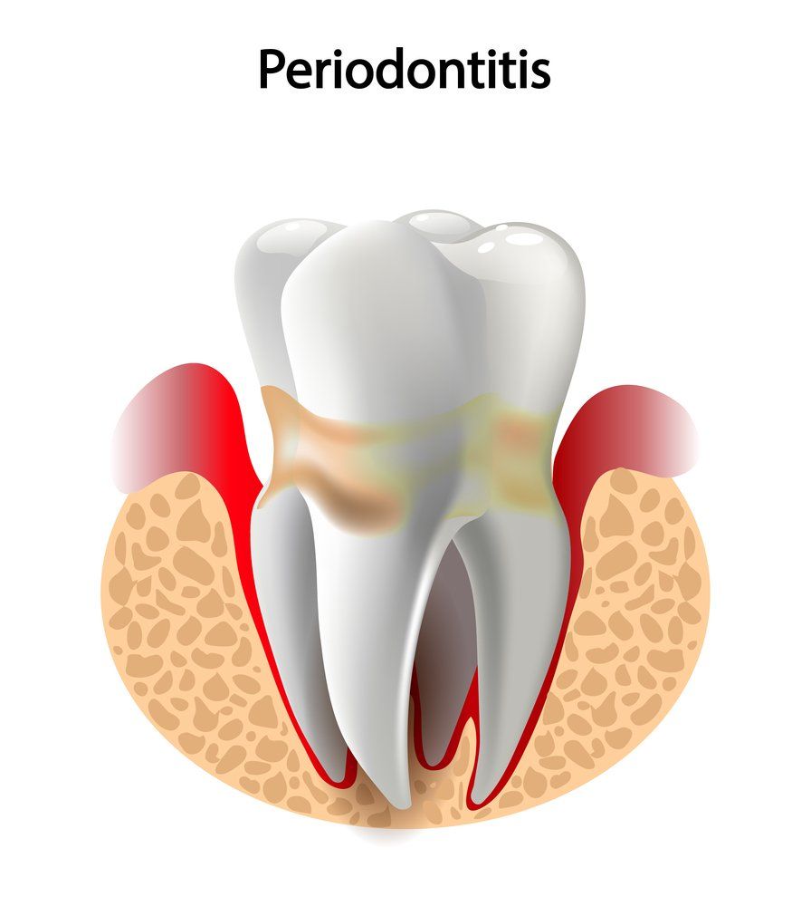 Illustration Of Periodontitis Disease — Dentistry Services in Cairns, QLD