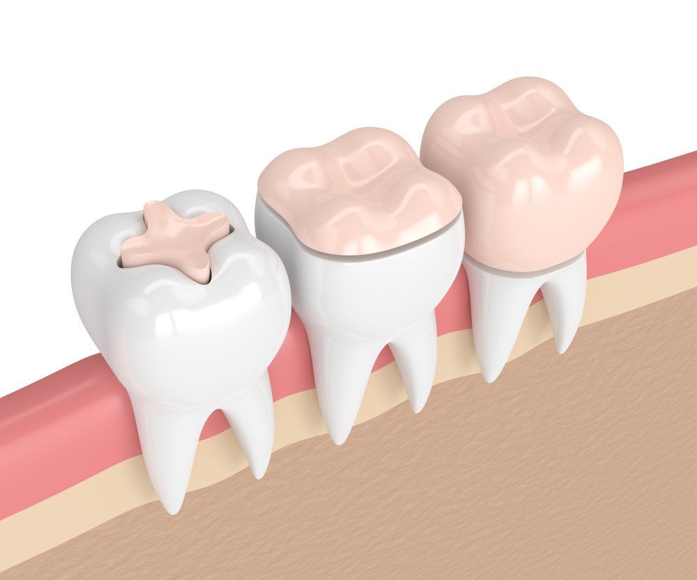 3d Render of Teeth With Filling — Dentistry Services in Cairns, QLD