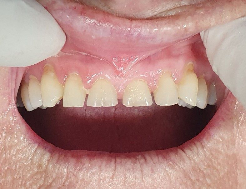 Dental before - The Dentist Cairns Dental Group