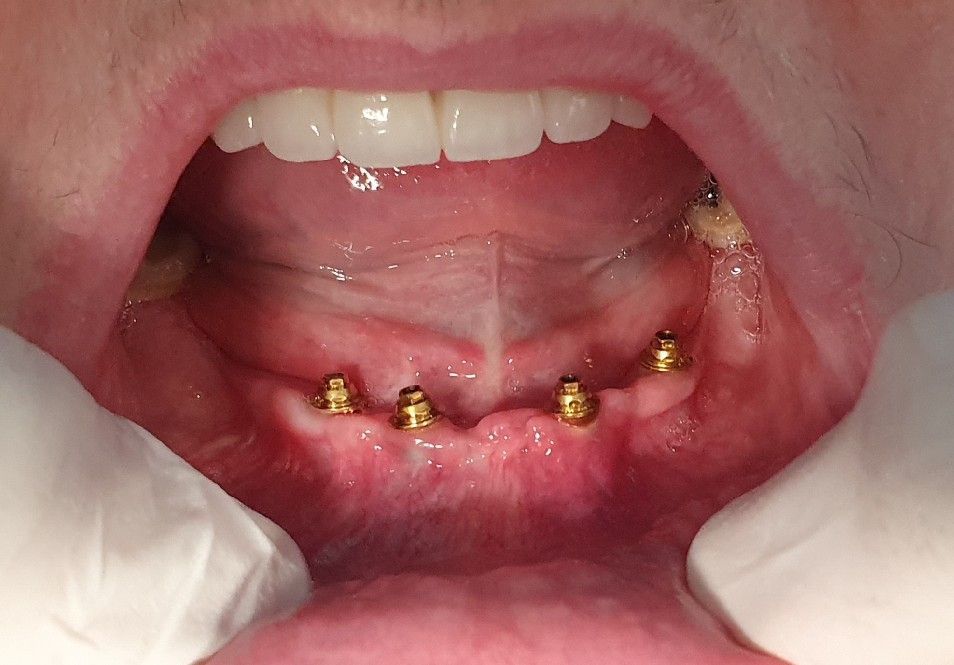 Dental Implants Before - The Dentist Cairns Dental Group