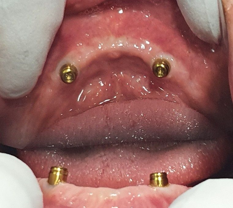 Dental Implants Before - The Dentist Cairns Dental Group