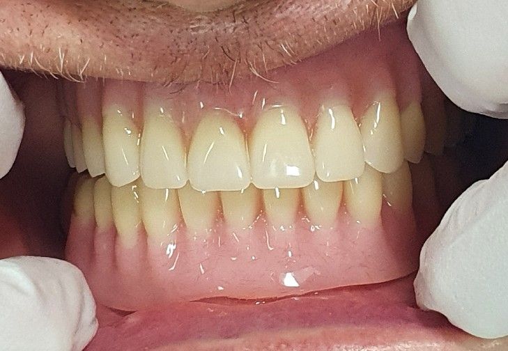 Dental Implants After - The Dentist Cairns Dental Group