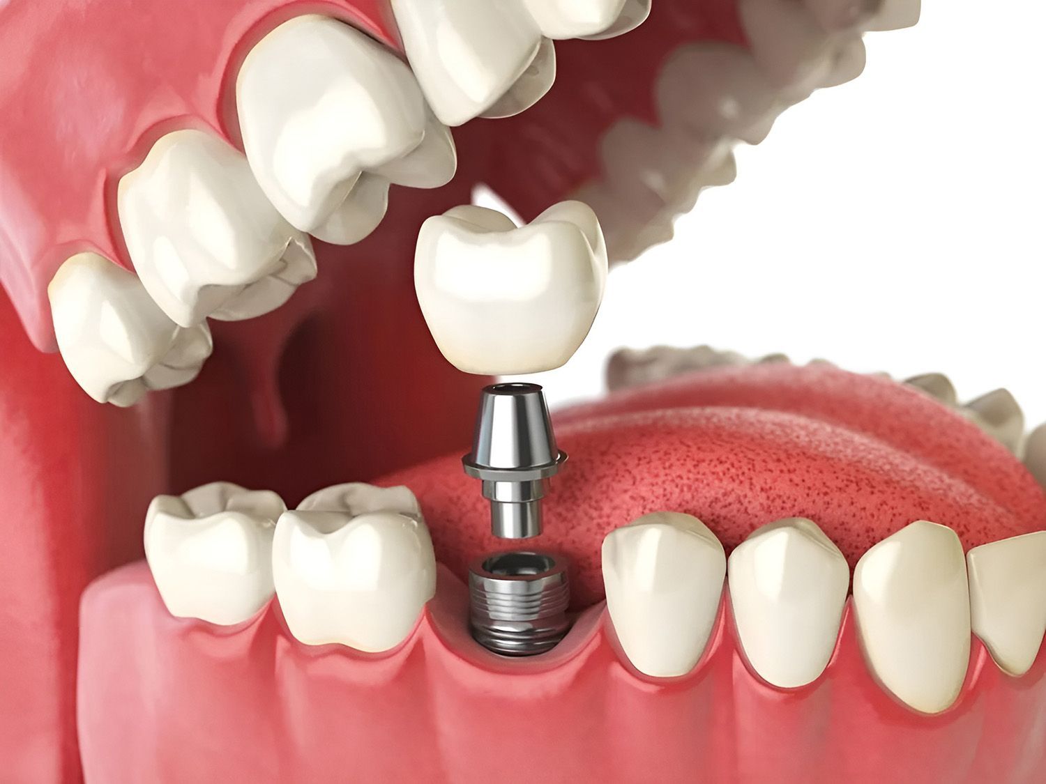 Dental Illustration Showing a Tooth Implant Process