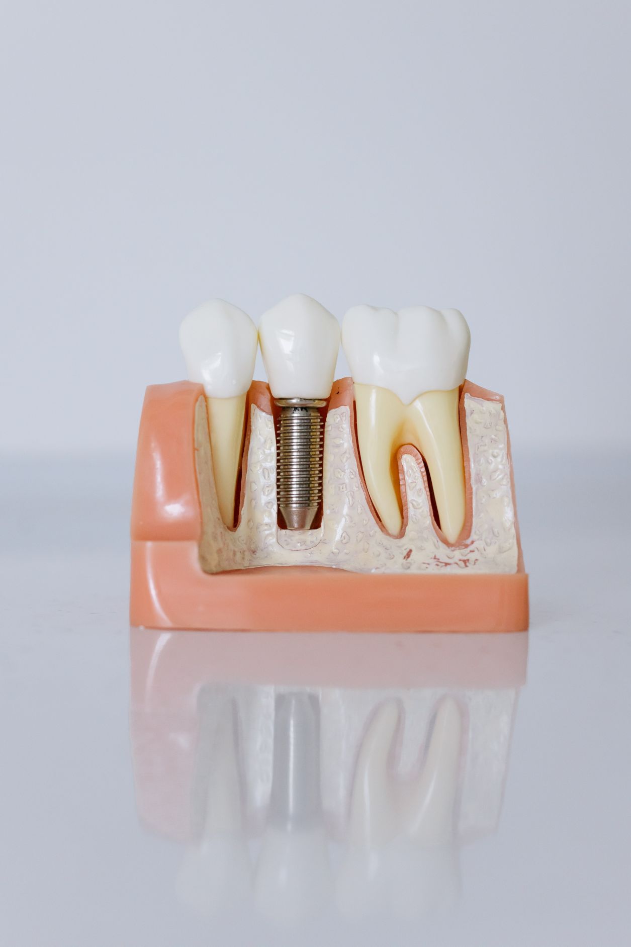 Model Of Teeth With Dental Implant — Dentistry Services in Cairns, QLD