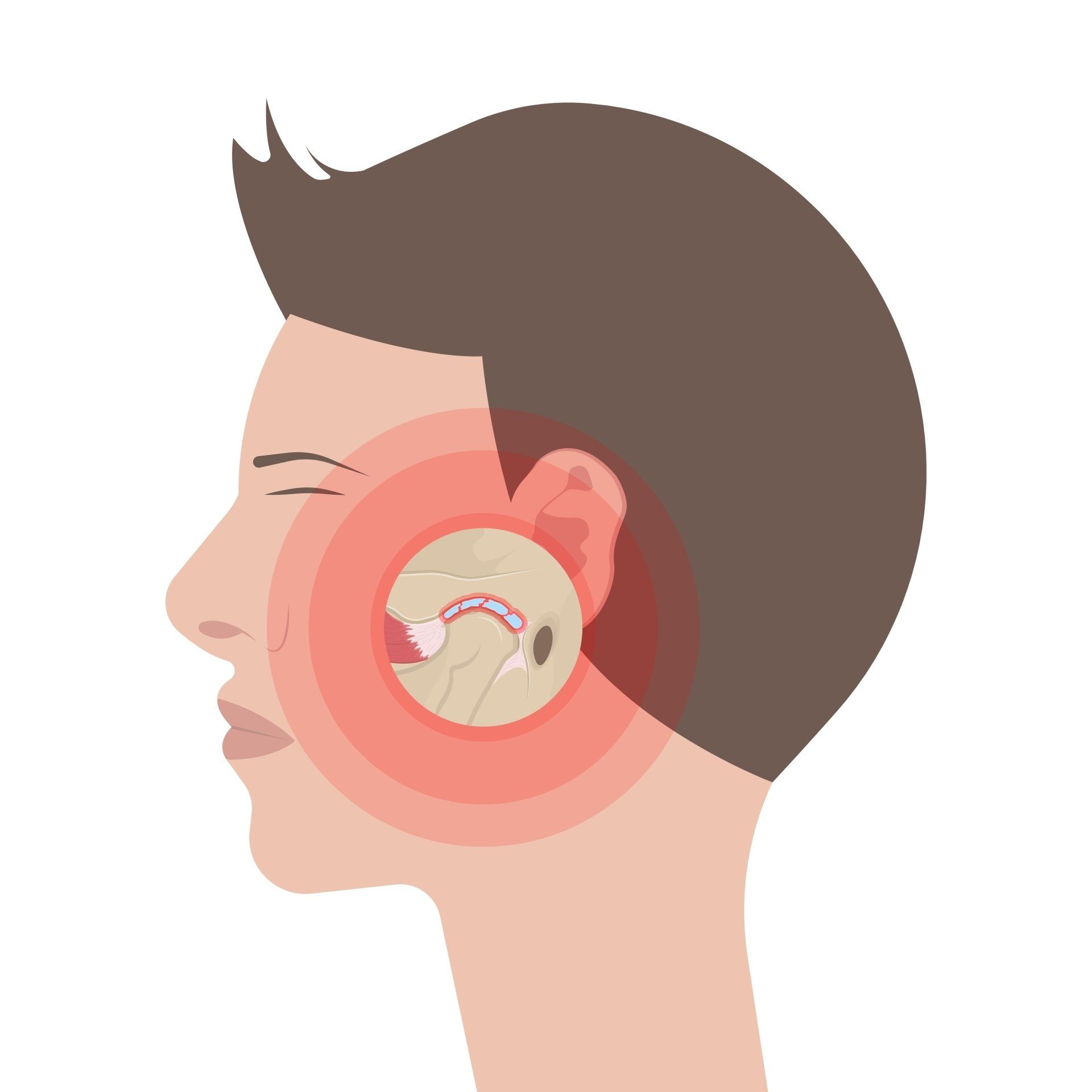 Illustration of Temporomandibular Joint Disorders  — Dentistry Services in Cairns, QLD