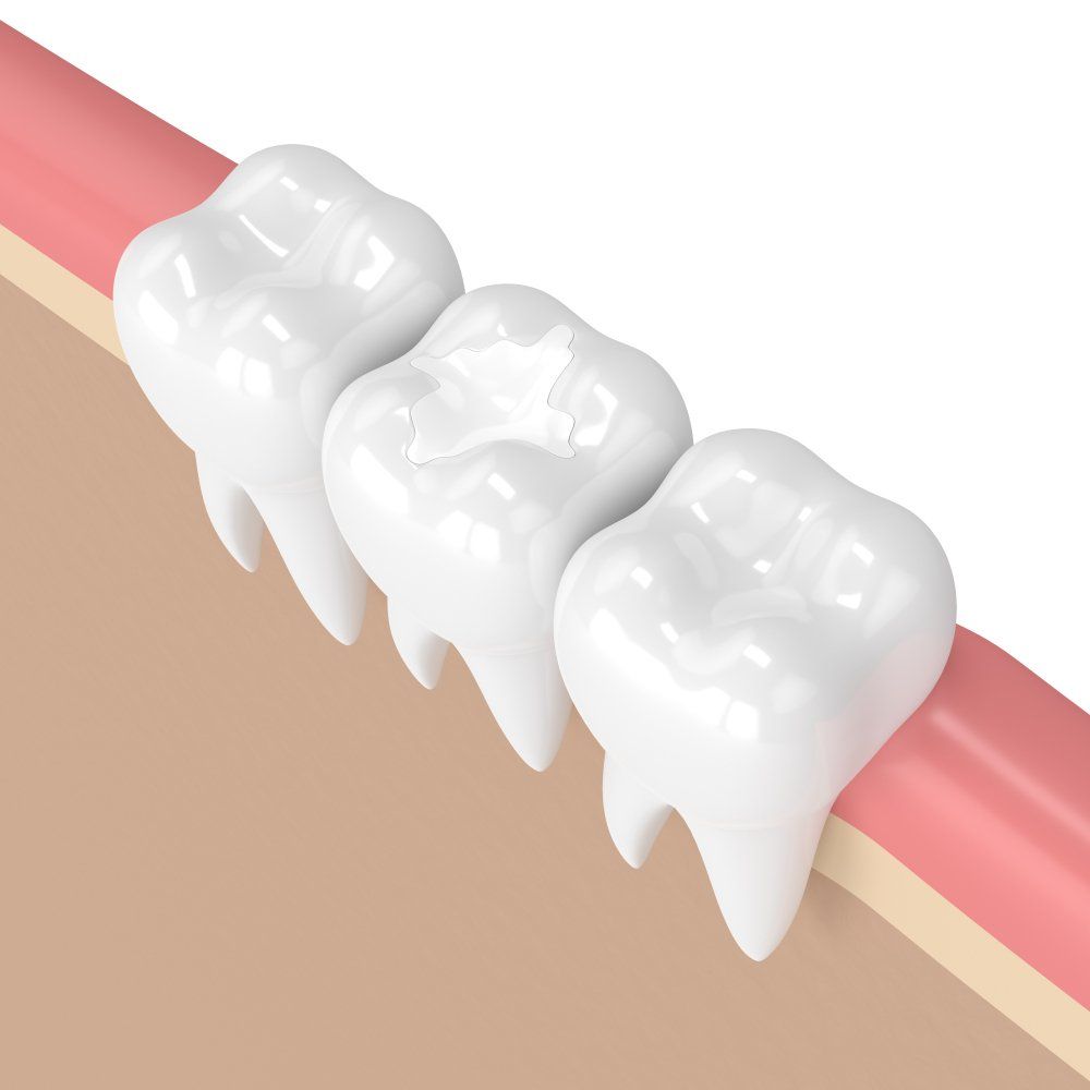 Render of Teeth With Dental Composite Filling — Dentistry Services in Cairns, QLD