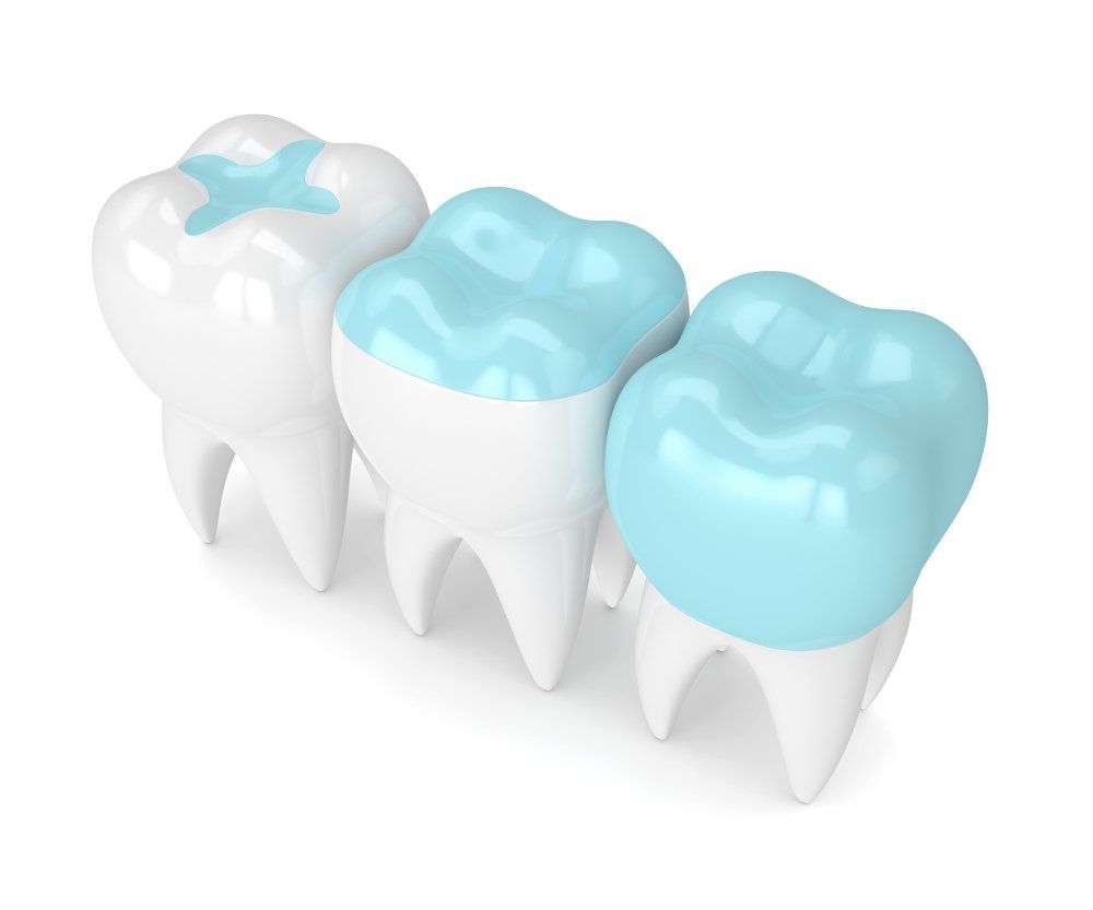 3d Render of Teeth With Inlay, Onlay and Crown Filling — Dentistry Services in Cairns, QLD