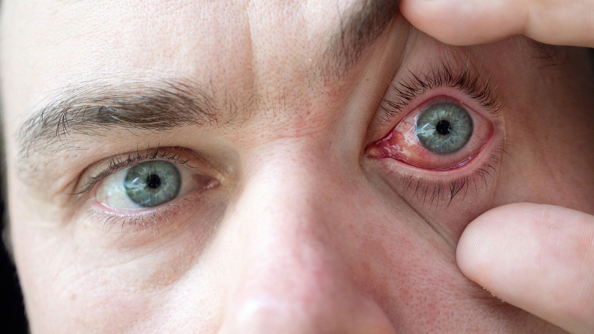 A close up of a man 's eye with a red eye.