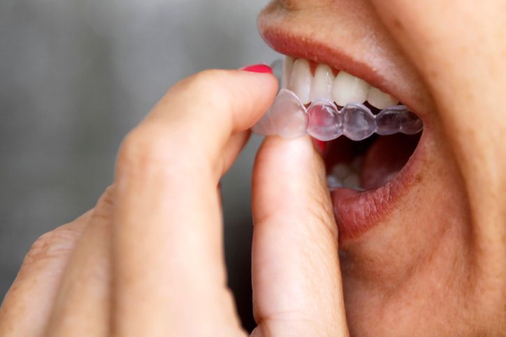 Dental patient inserting Invisalign clear aligners to correct teeth alignment with invisible braces.