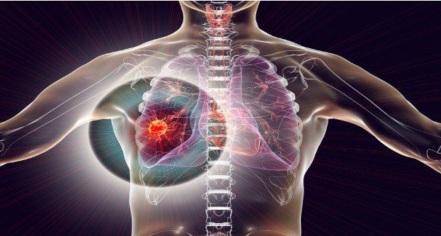 how-does-lung-cancer-progress-timeline-what-to-expect