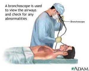 Illustration of Bronchoscopy