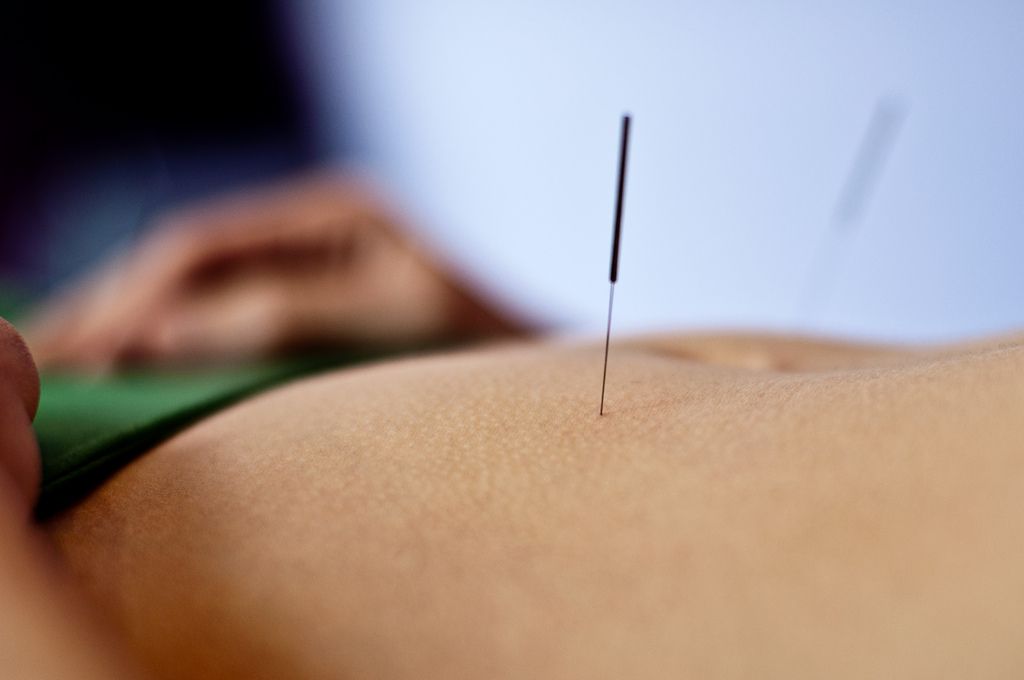Acupuncture needles inserted into a person's abdomen.