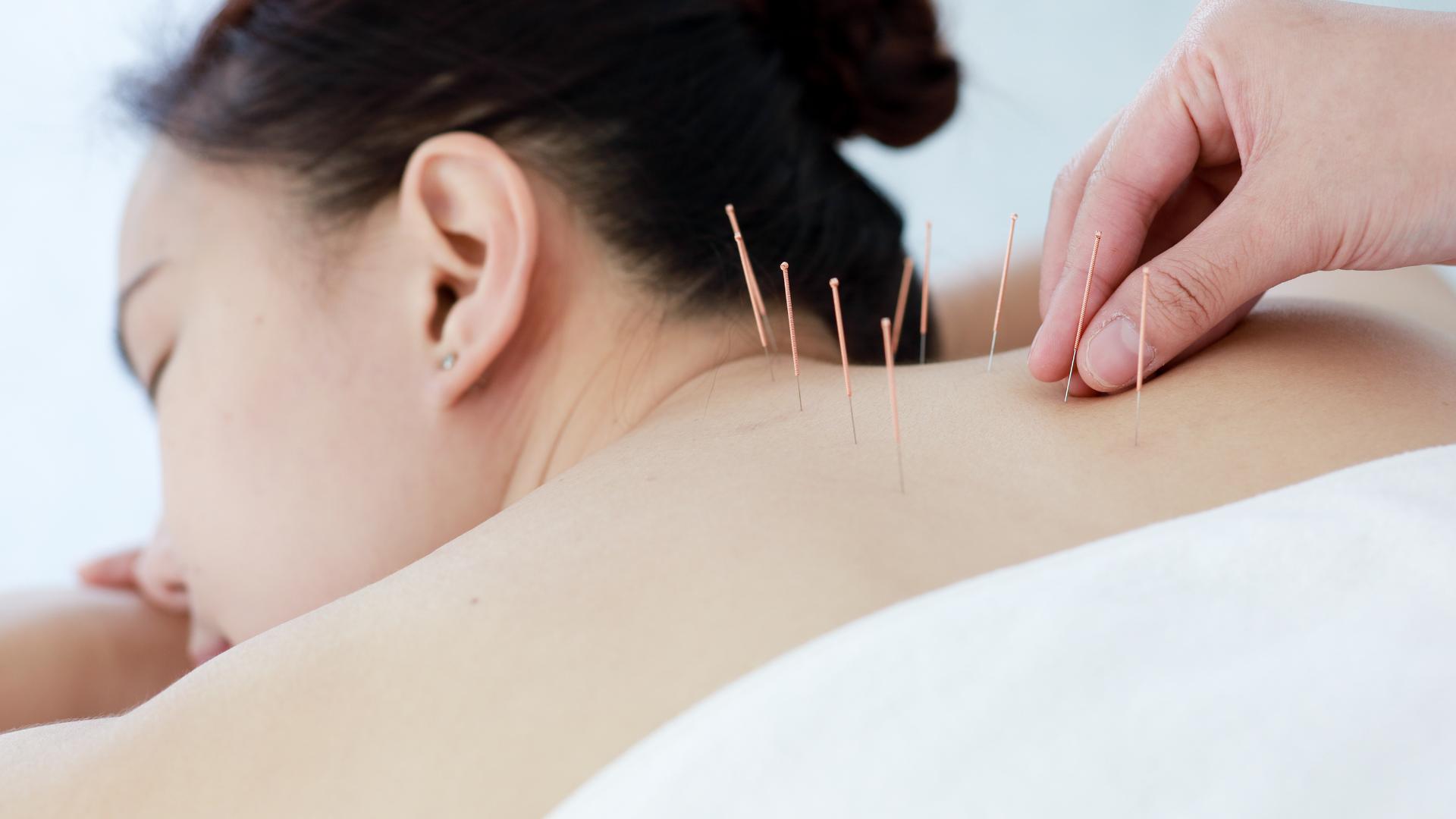 Acupunctured back