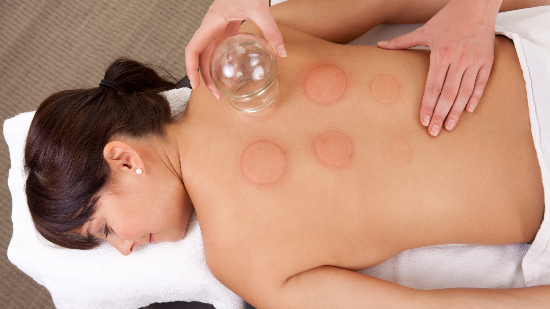 Woman receiving cupping therapy on her back; red circular marks from the cups.