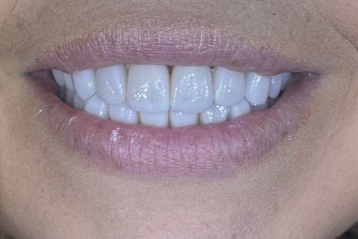 A close up of a woman 's mouth with white teeth.