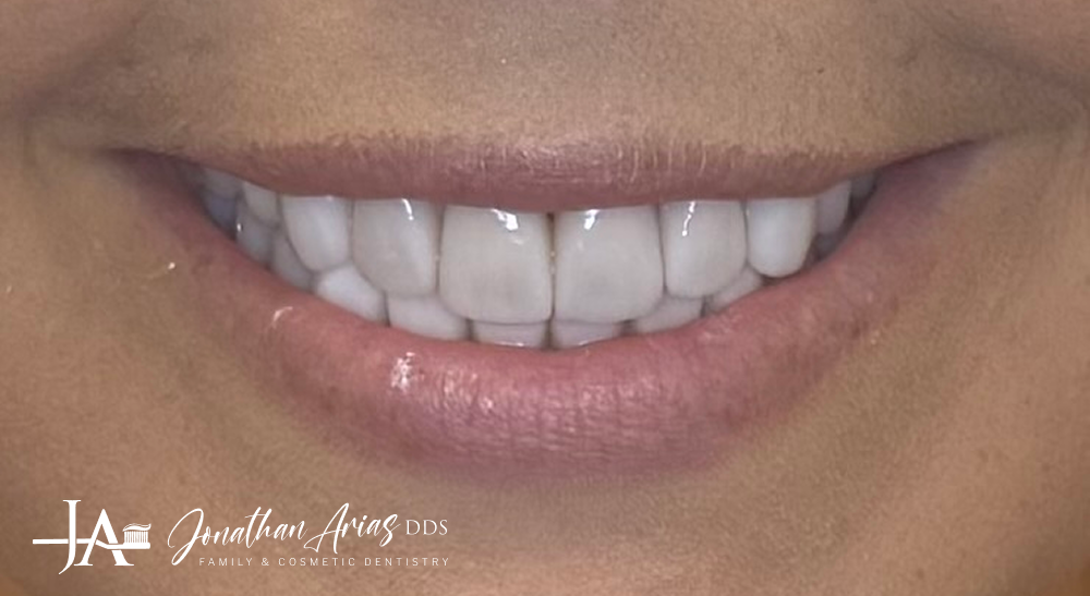 A close up of a woman 's smile with white teeth.