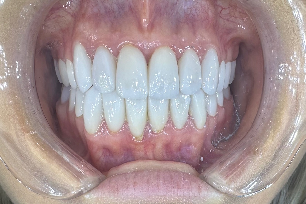 A close up of a person 's mouth with a mouth guard on.