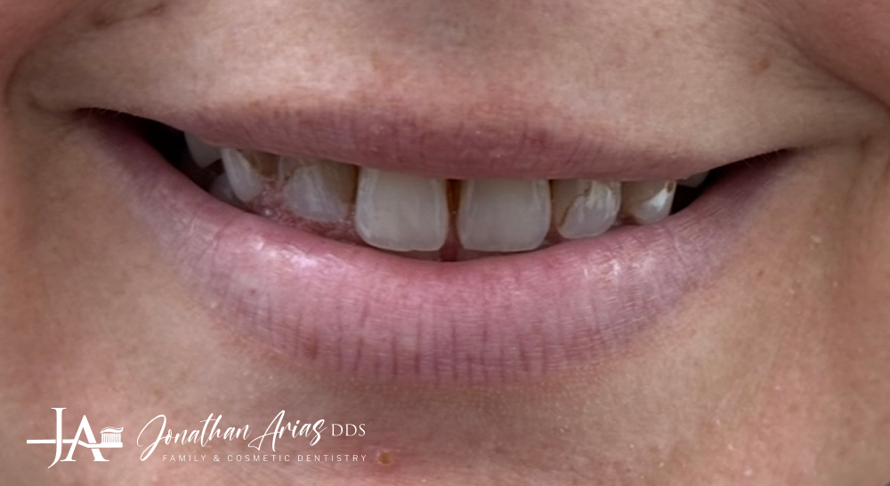 A close up of a person 's mouth with very dirty teeth.