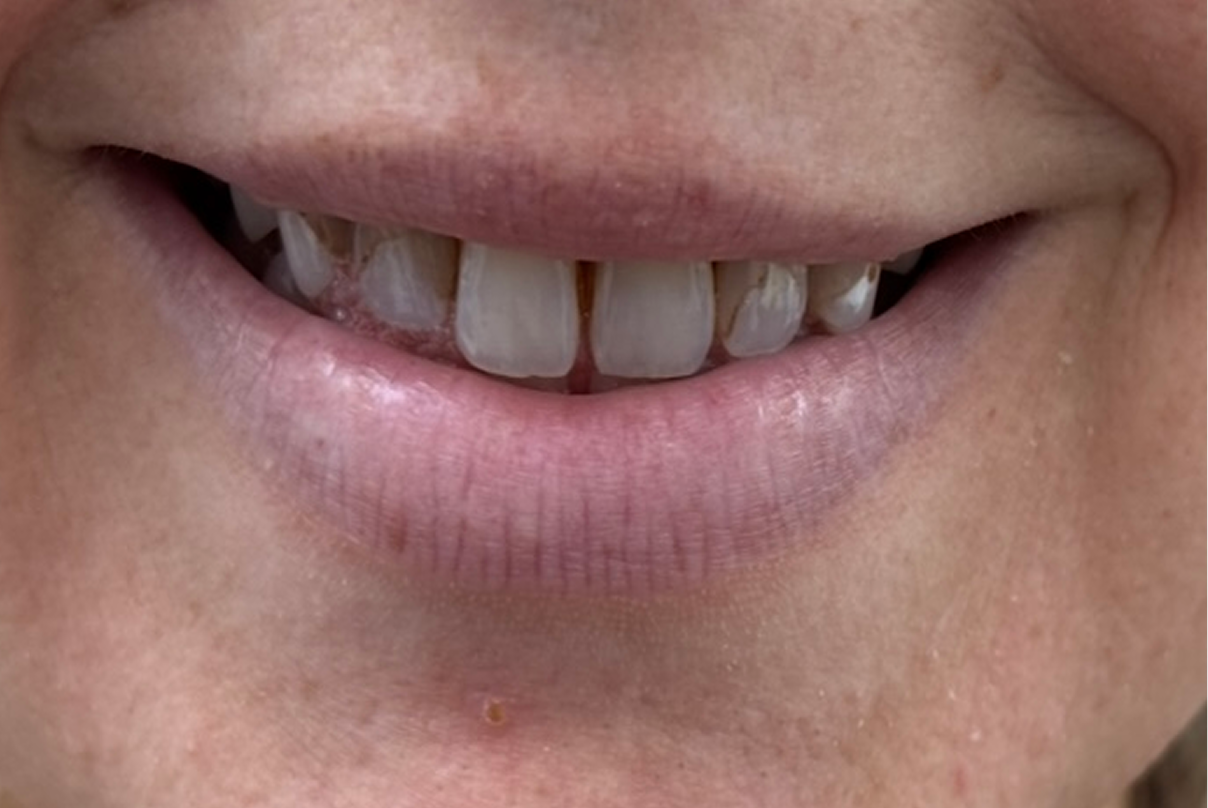 A close up of a person 's mouth with missing teeth.