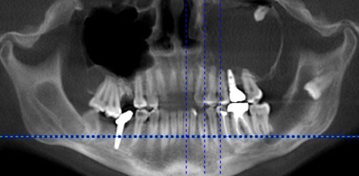 Zahnpanoramaröntgen. Kiefer mit mehreren Zahnimplantaten und fehlenden Zähnen.