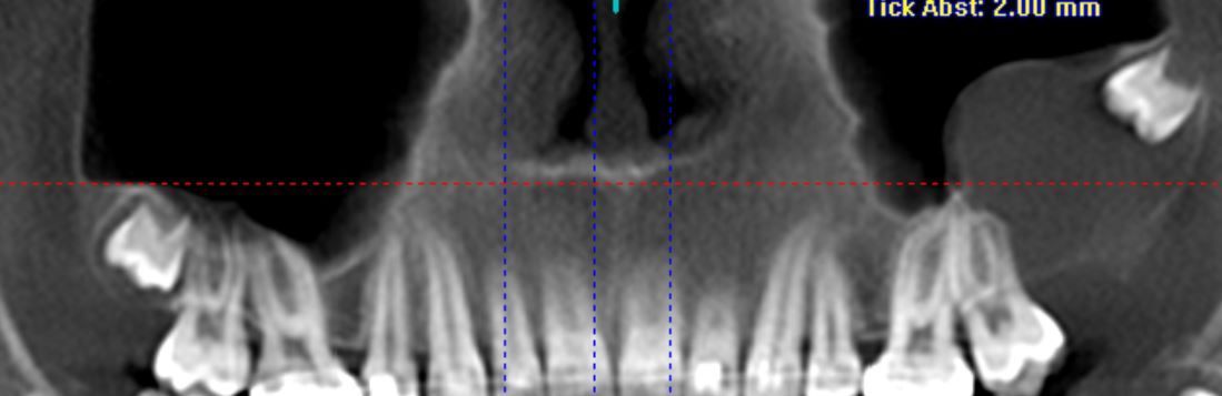 Zahnröntgenaufnahme des Oberkiefers einer Person mit Zähnen, Nebenhöhlen und Nasenhöhle.