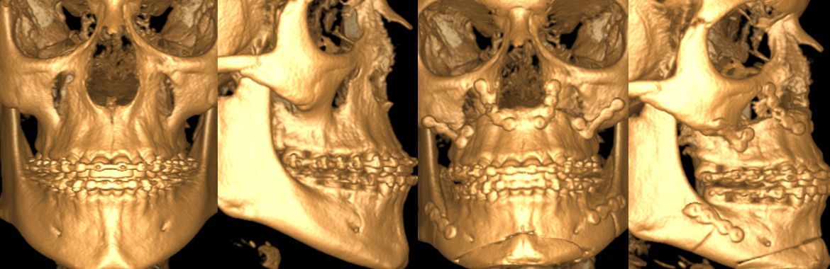 3D-gerenderte Bilder eines menschlichen Schädels aus verschiedenen Winkeln.