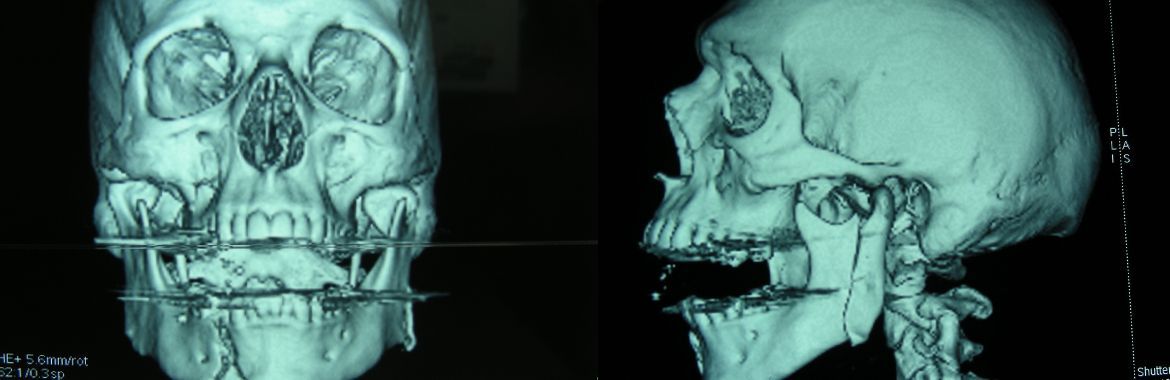 Röntgenaufnahme eines menschlichen Schädels, die eine Frontal- und Profilansicht in Blaugrüntönen zeigt.