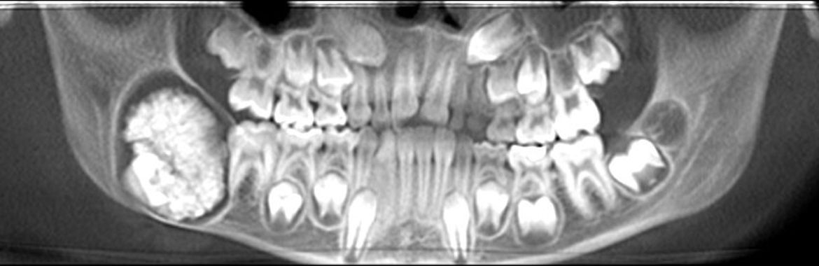 Panorama-Röntgenaufnahme des Mundes eines Kindes.