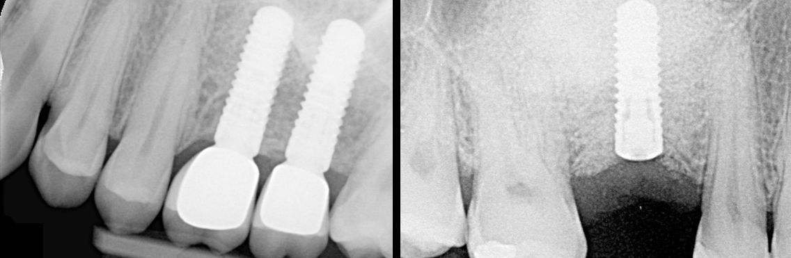 Zahnröntgenaufnahme mit Zähnen mit Zahnimplantaten; ein Implantat rechts, zwei Implantate links.