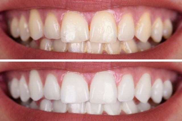 Before-and-after Close-up of Teeth Whitening, Showing Brighter Teeth in the Lower Image — Smiles On Hobart in Sandy Bay, TAS