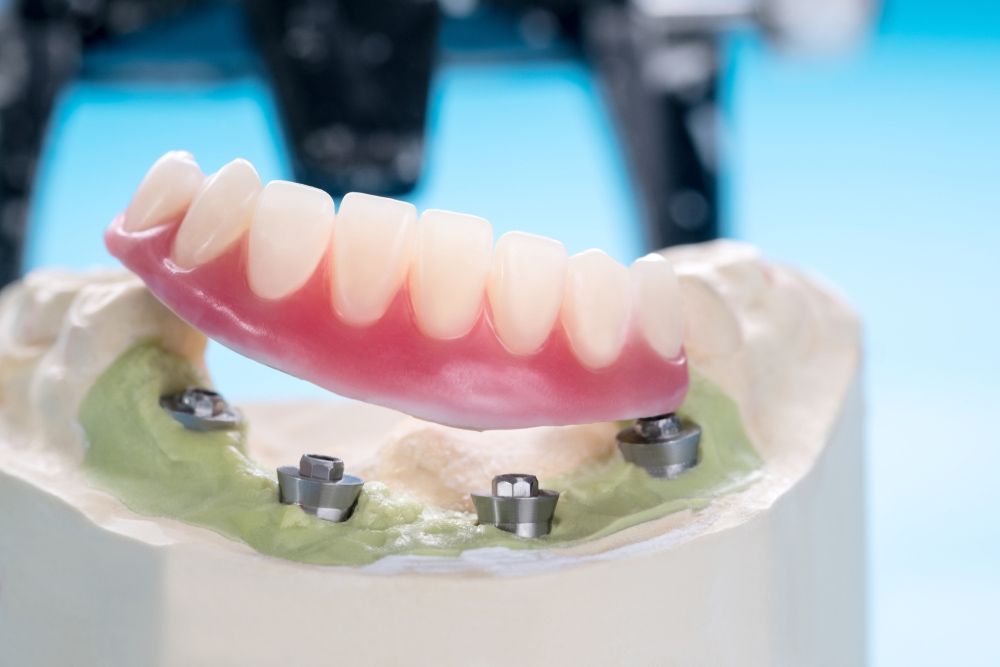 Pink Dental Prosthetic on a White Model Jaw With Metal Implant Posts — Smiles On Hobart in Hobart, TAS