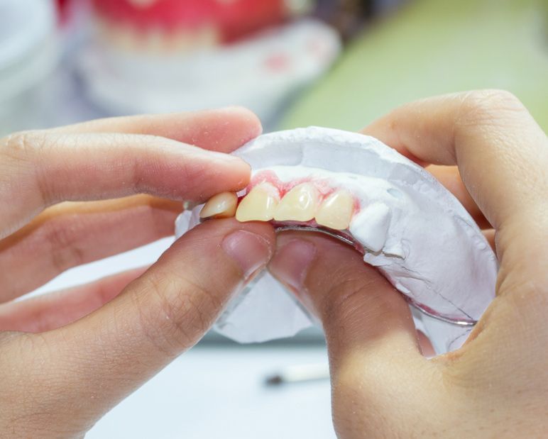 Hands Holding a Dental Mold With White Teeth Impression and Red Gum Detail — Smiles On Hobart in Hobart, TAS