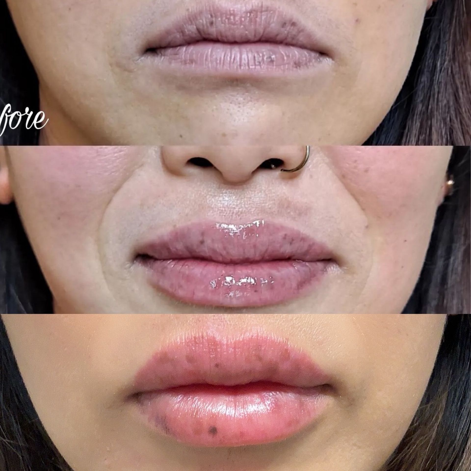 A before and after picture of a woman 's lips with filler