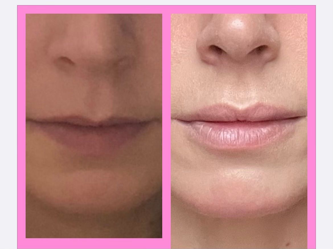 A before and after picture of a woman 's lip augmentation