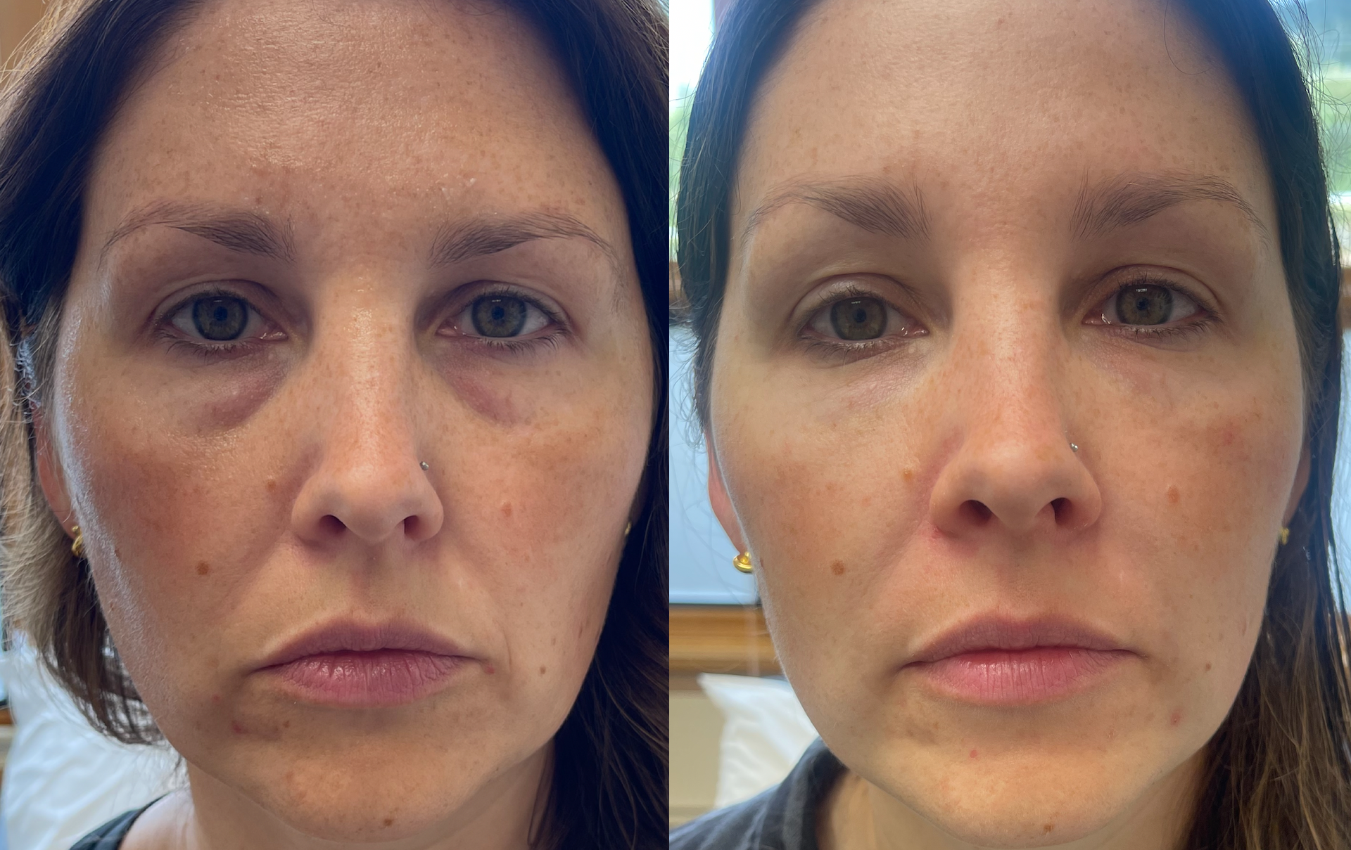 A before and after photo of a woman 's face with rejuvenation.