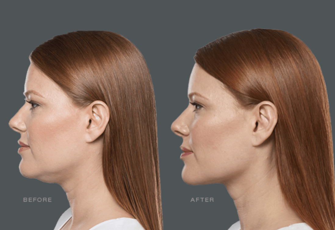 A before and after photo of a woman 's face with Kybella