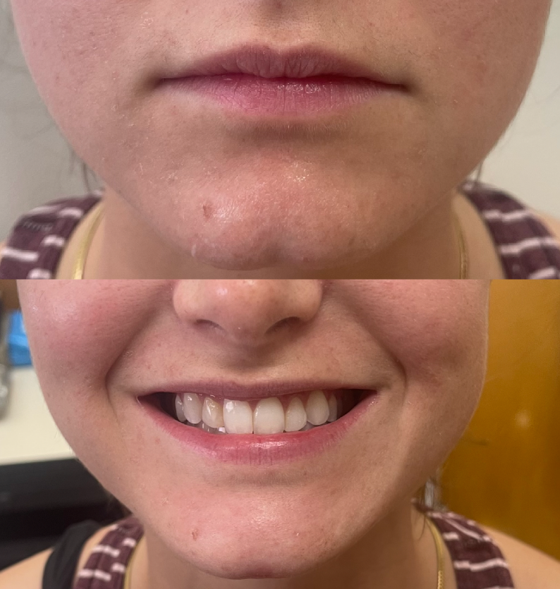 A before and after photo of a woman 's chin dermal filler