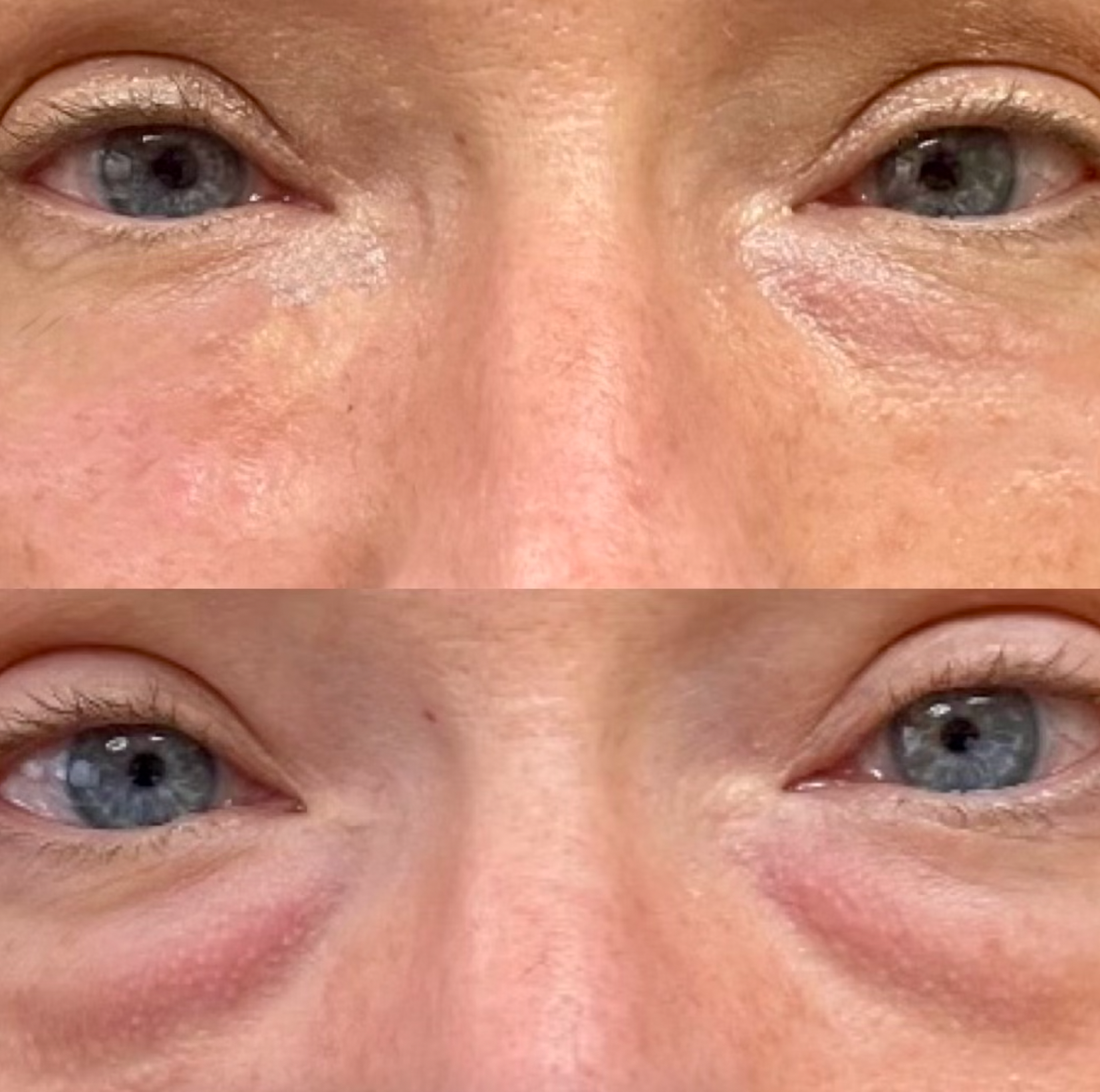 A before and after picture of a woman 's eyes with tear trough filler.