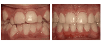 crowding of teeth - before and after