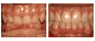 deep overbite - before and after