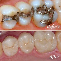before and after dental fillings
