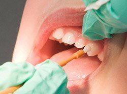 dentist applying dental fluoride to patient