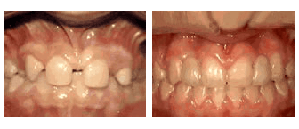missing lateral incisors - before and after