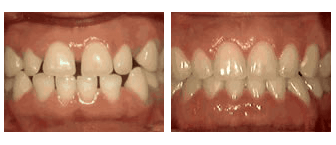 Spacing of teeth - before and after