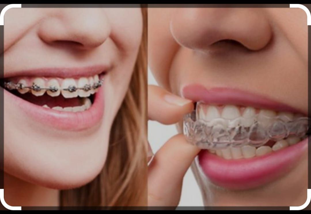 Comparación lado a lado: persona con aparatos metálicos y persona insertando un alineador transparente en la boca.